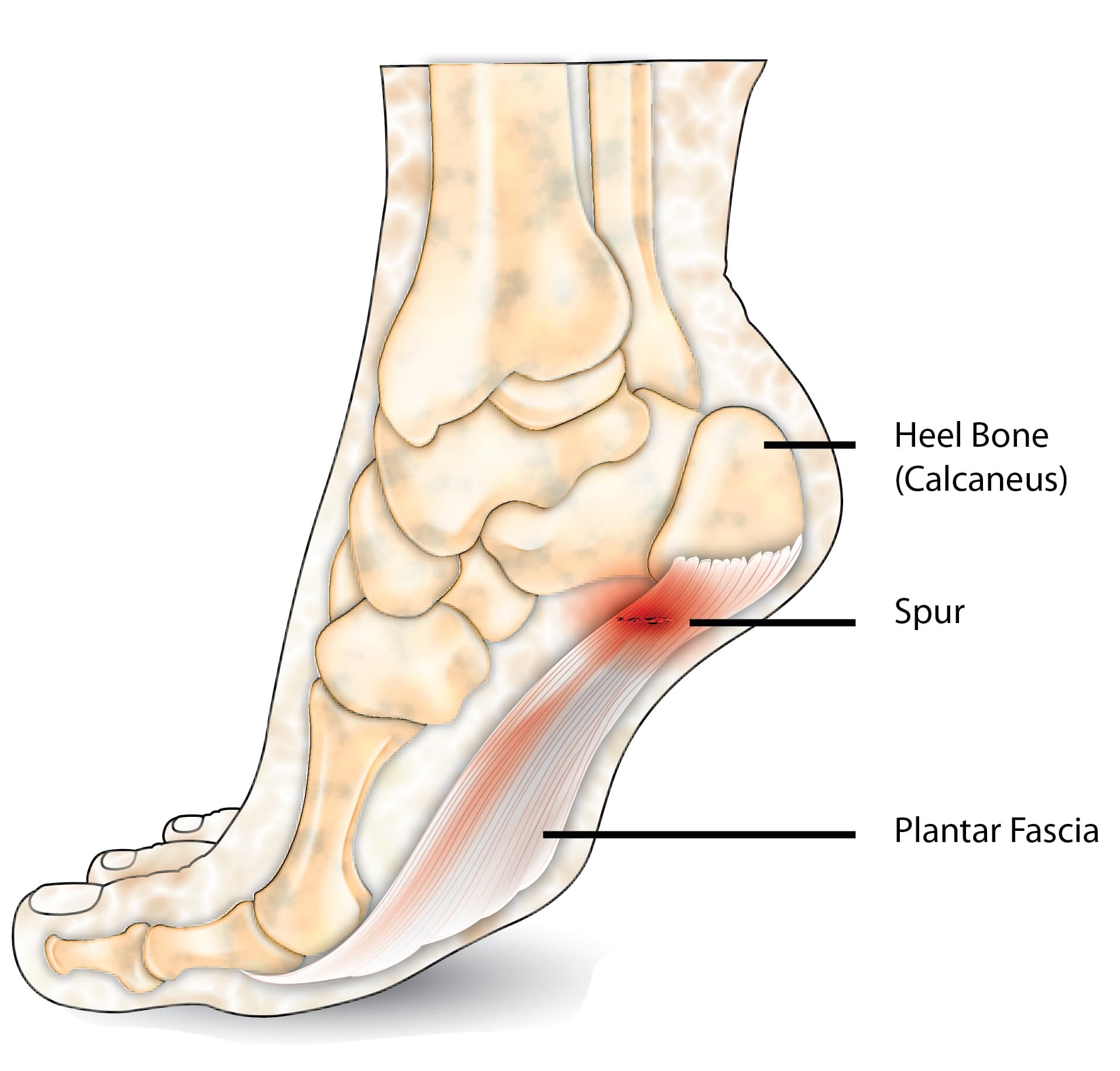 symptoms of spurs in feet