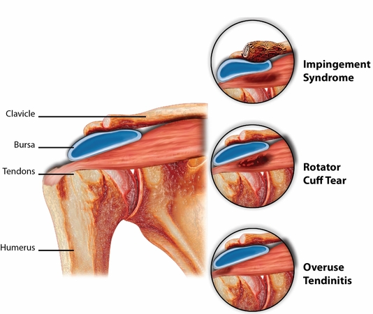 Rotator Cuff Injury Explained. Including Rotator Cuff Tear