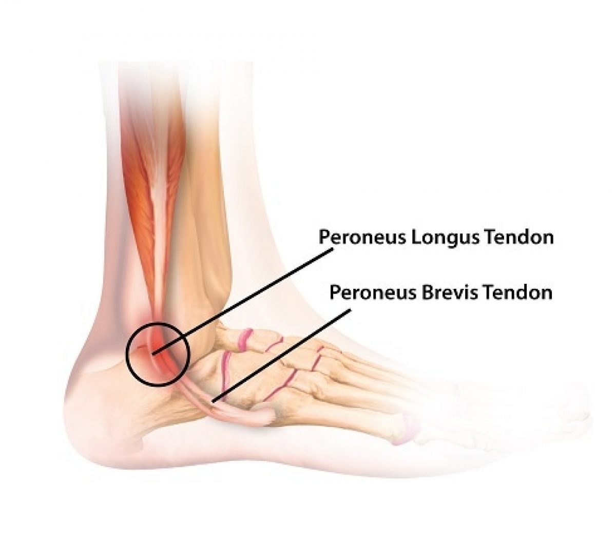 Peroneal Tendonitis - Causes, Symptoms and Treatments