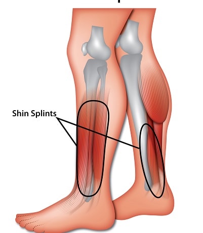 Shin Splints - Symptoms, Causes and Diagnosis | SportNova UK
