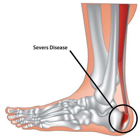 sever's disease achilles tendon