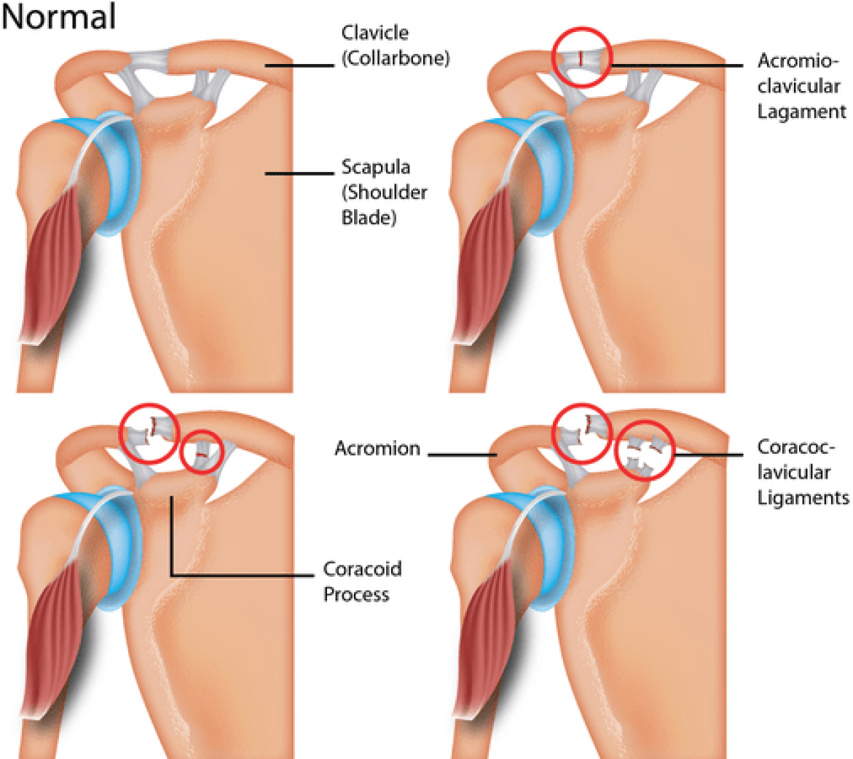 acromioclavicular joint separation treatment